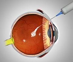 Image_Intravitreal injection treatment_Macular degeneration_treatment