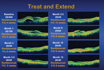 Picture_Macular Lesion Treatment_Vitreomy_Injection_Treatment Time