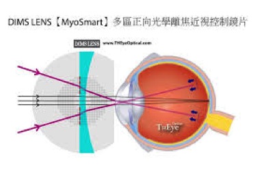 圖片_控制近視鏡片_多區光學