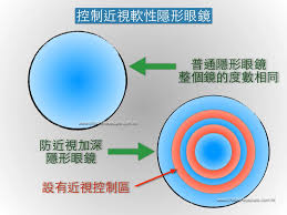 圖片_近視控制軟性隱形眼鏡