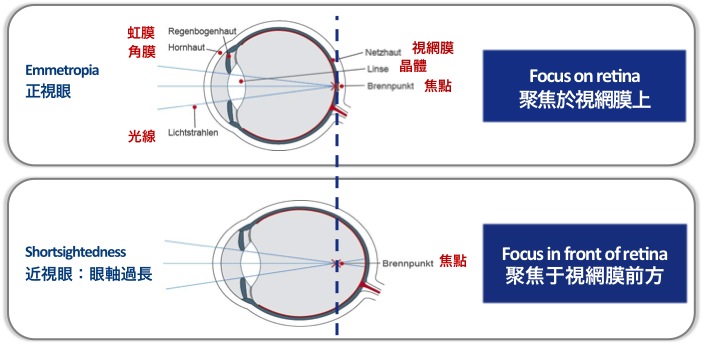 圖片_近視眼_眼軸過長
