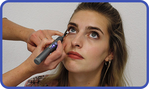 Dry eye BlephEx eyelid hygiene