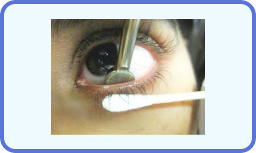 Dry eye meibomian gland squeeze oil