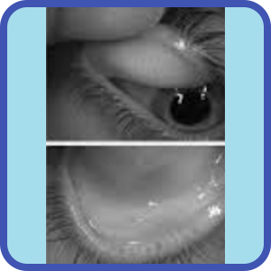 Meibomian gland dysfunction test