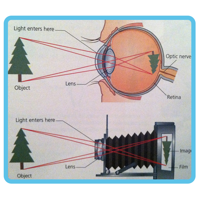 Picture_Senile_Cataract symptoms